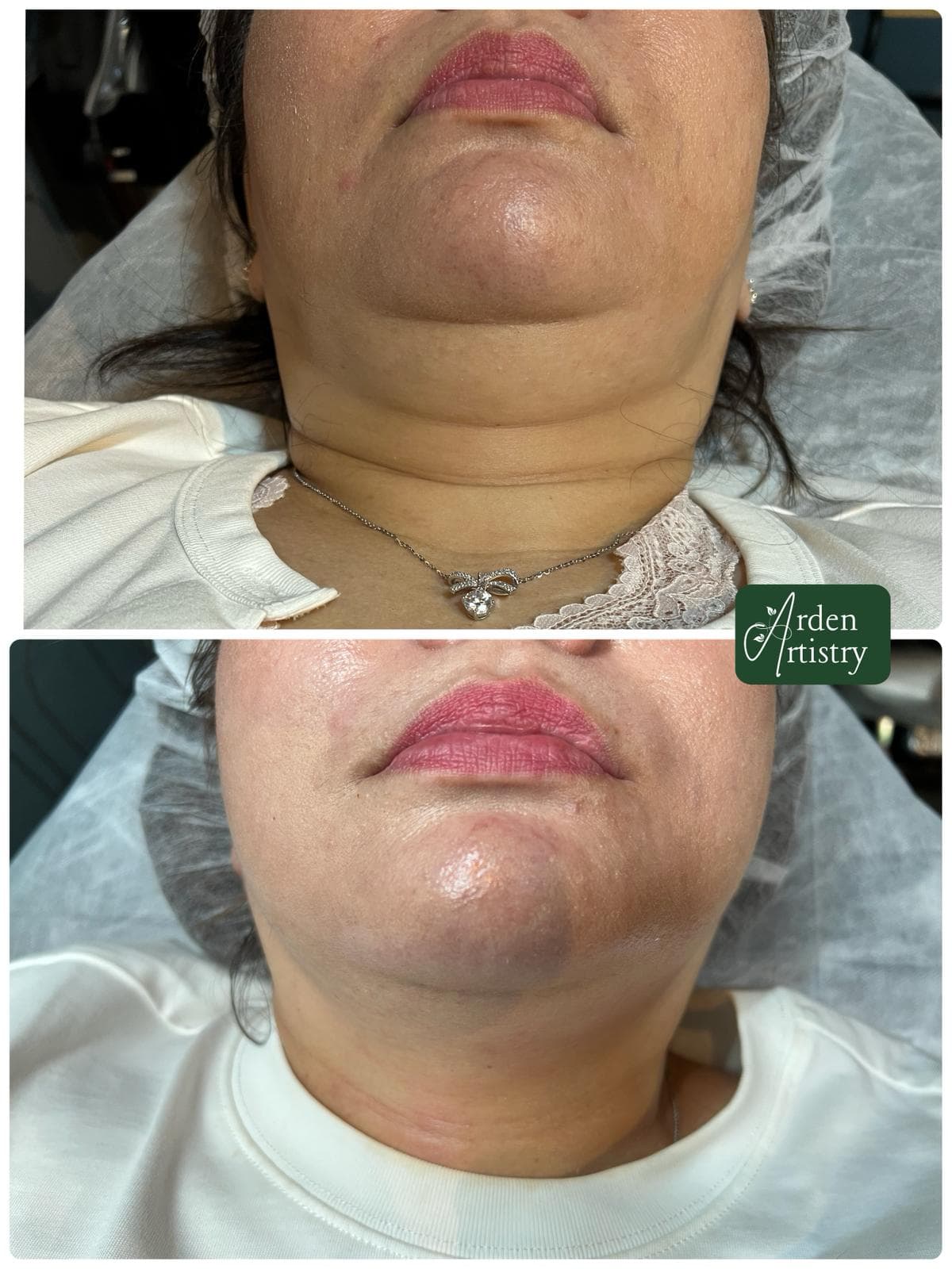 Double-chin contouring client result reference 1