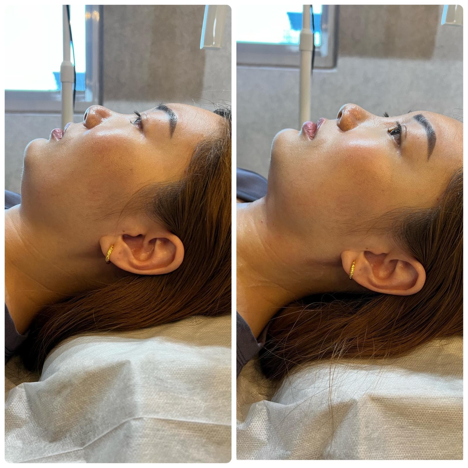 Jawline refinement client result reference 2