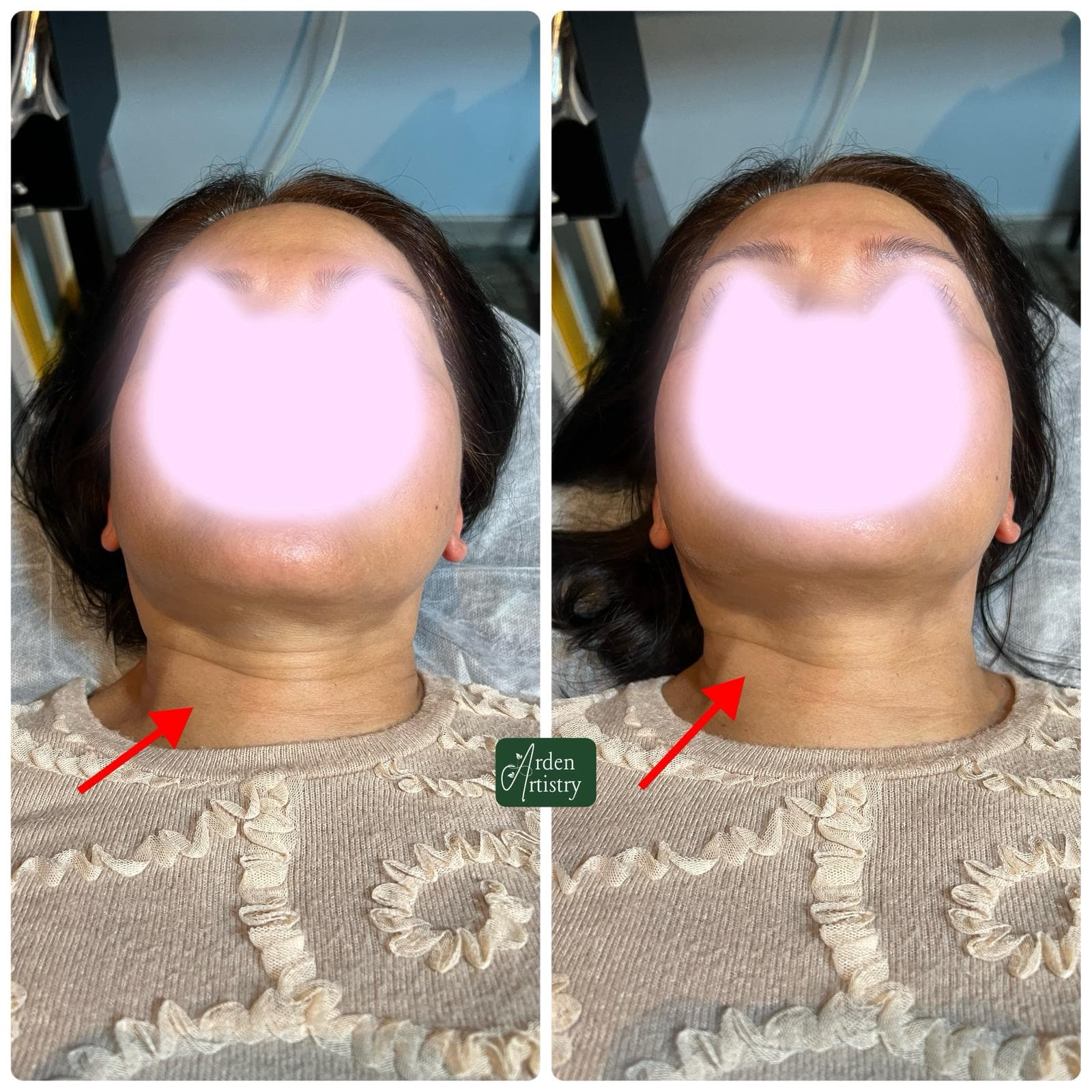 Double-chin reduction client result reference 4
